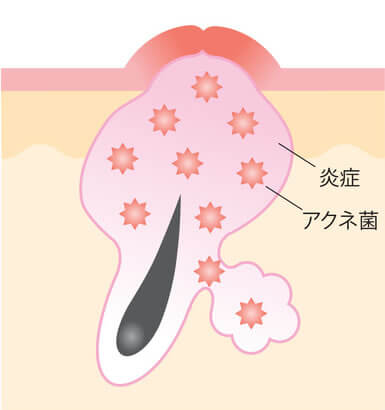赤にきび(炎症にきび)